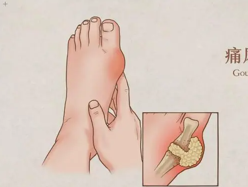 痛风的快速止痛的方法