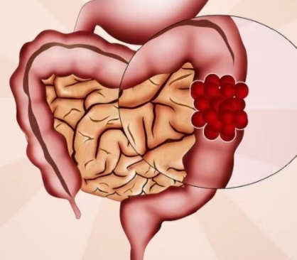4个最为明显的肠癌信号
