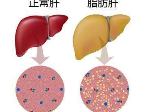 脂肪肝怎么调理最好最快