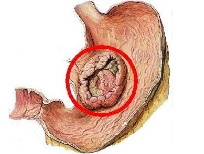 胃癌的五大早期症状