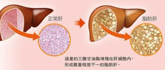 脂肪肝怎么调理最好最快?这五个方法，快速调离好肝脂肪